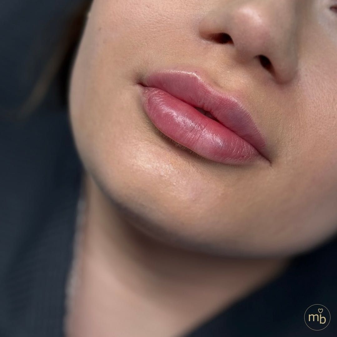 Efekty zabiegu Marsi Beauty