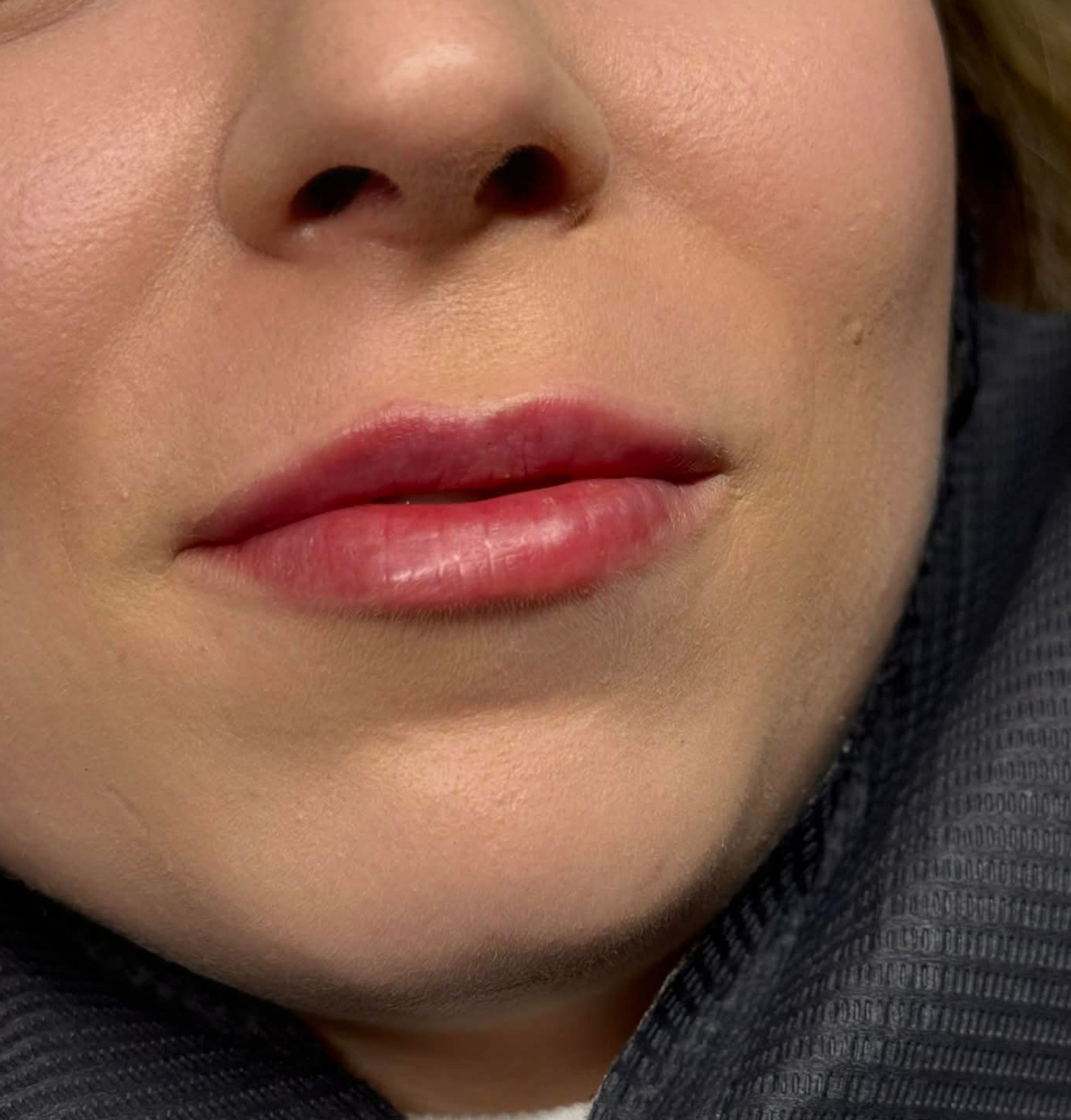 Efekty terapii skóry Marsi Beauty przed i po