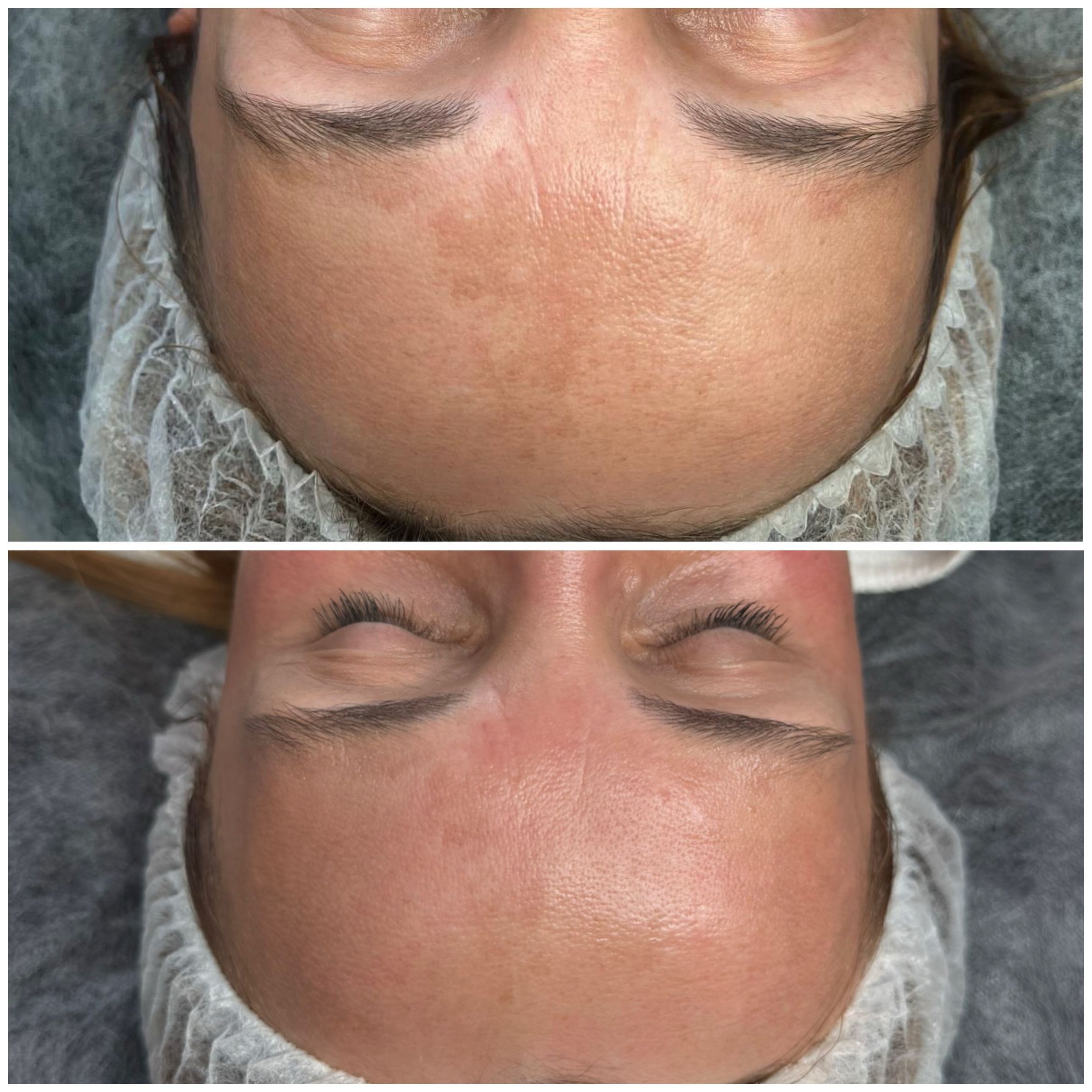 Efekty terapii skóry Marsi Beauty przed i po