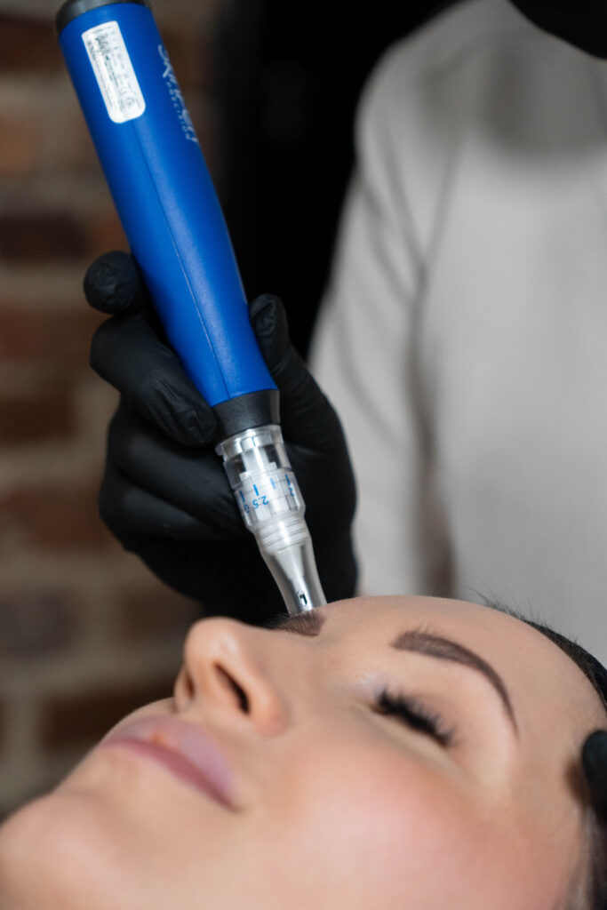 SKINPEN – MEZOTERAPIA MIKROIGŁOWA