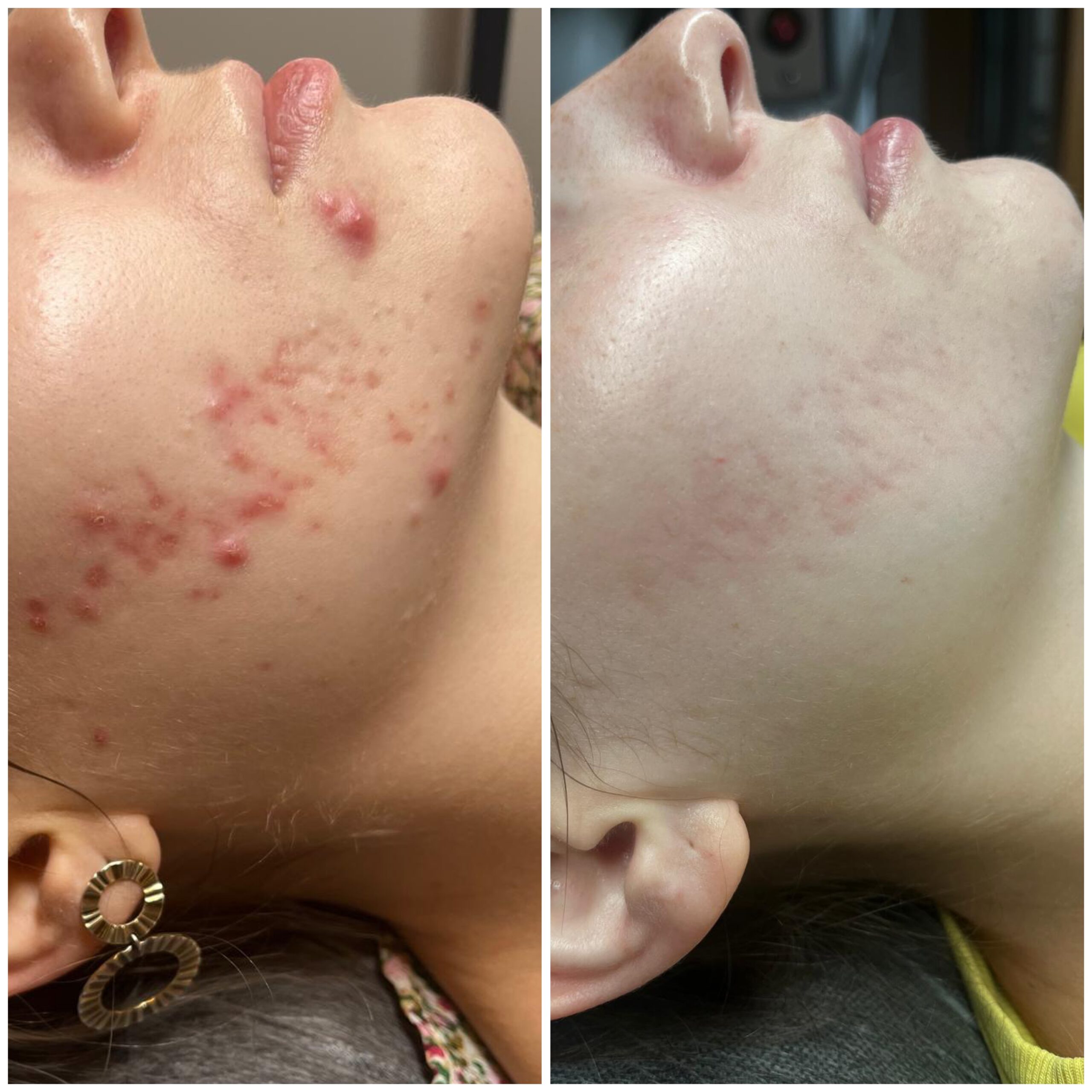 Efekty zabiegów Marsi Beauty przed i po