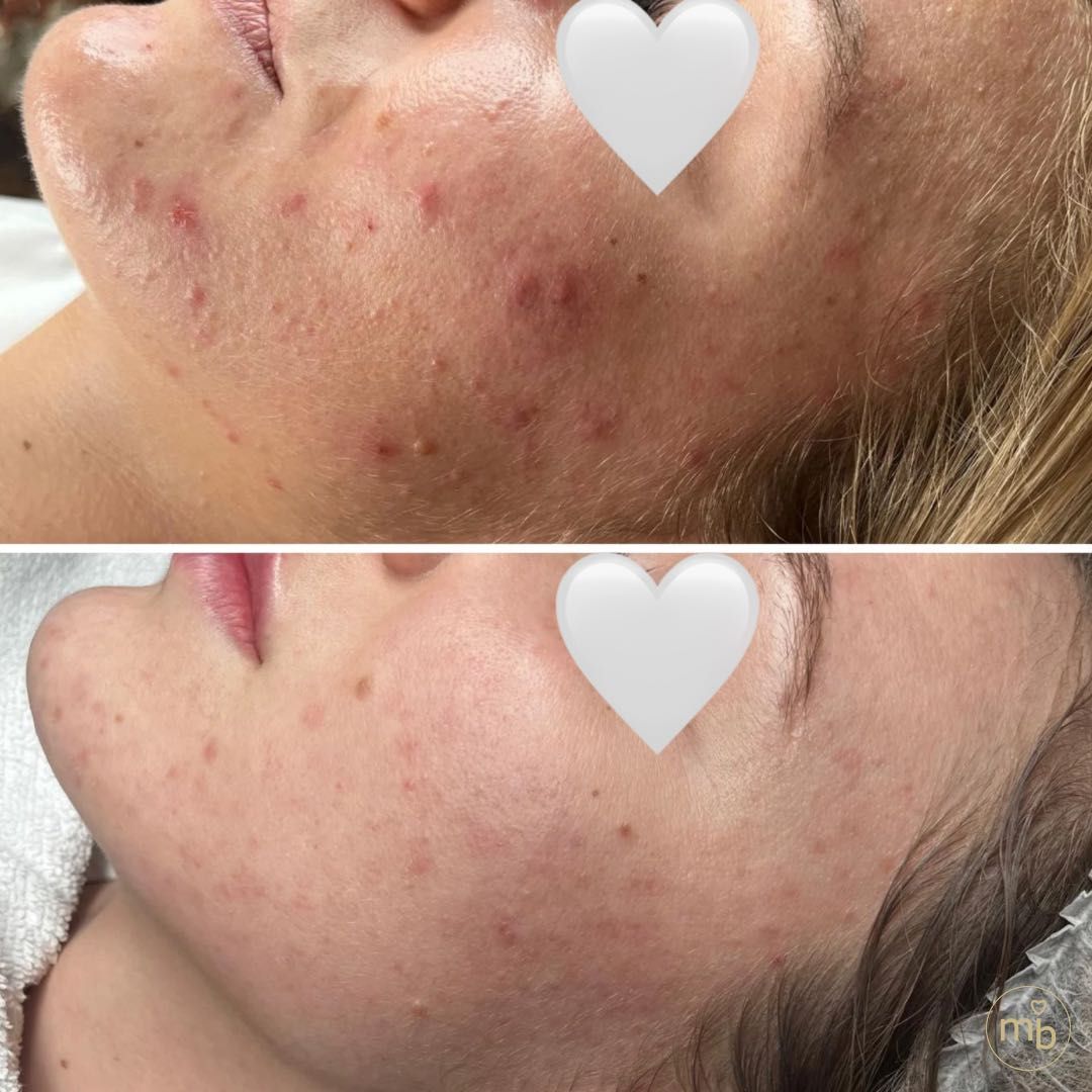 Efekty zabiegów Marsi Beauty przed i po